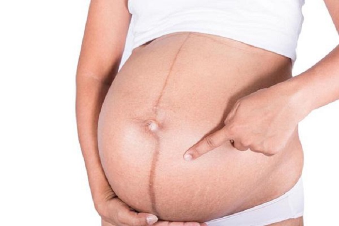 Đường lông bụng nổi rõ ở phụ nữ mang thai