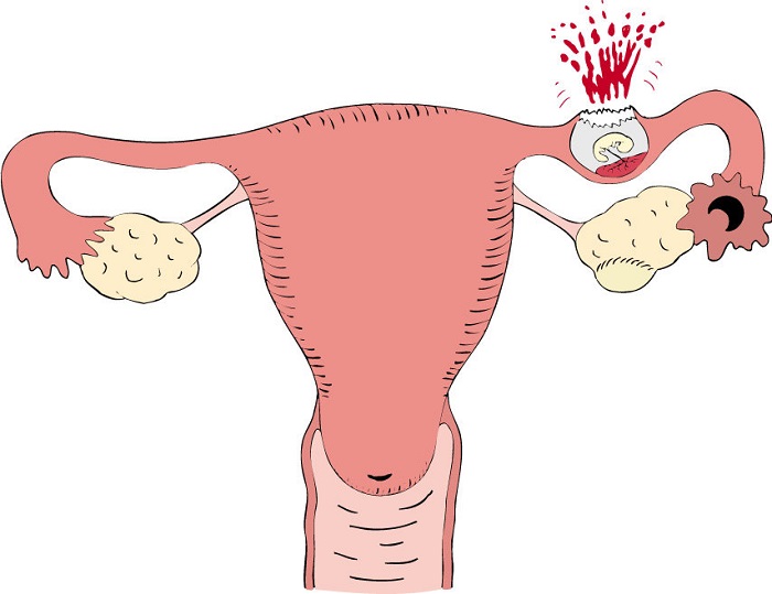 Thai ngoài tử cung là một bệnh lý thường gặp ở phụ nữ