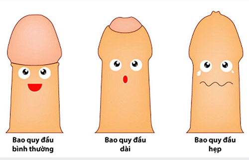 Hẹp bao quy đầu