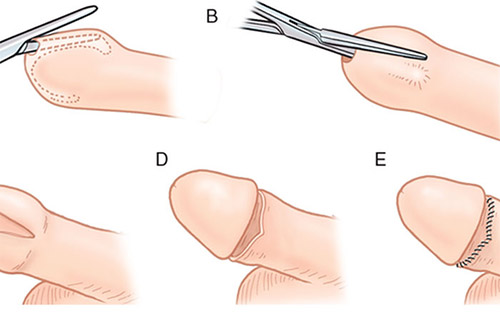 Thủ thuật cắt bao quy đầu