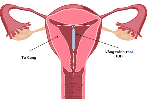 Thủ thuật đặt vòng tránh thai