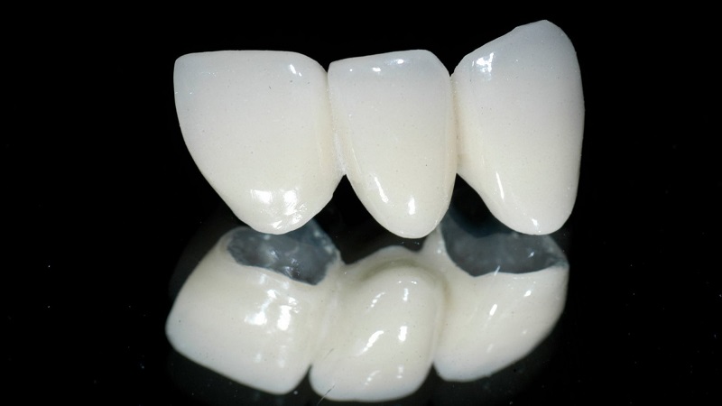 Răng sứ Titan có giá thành phù hợp với mọi phân khúc khách hàng