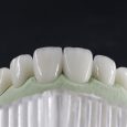 Răng sứ Zirconia có độ bền rất cao