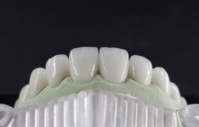 Răng sứ Zirconia có độ bền rất cao