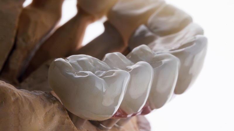 Giá bọc sứ cho răng sâu phụ thuộc vào nhiều yếu tố  