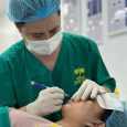 Cắt mí an toàn không để lại SẸO